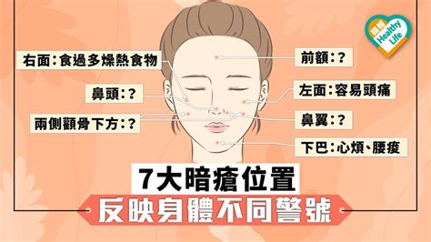 暗瘡位置|【暗瘡位置】不同代表什麼？中醫教如何處理及預防